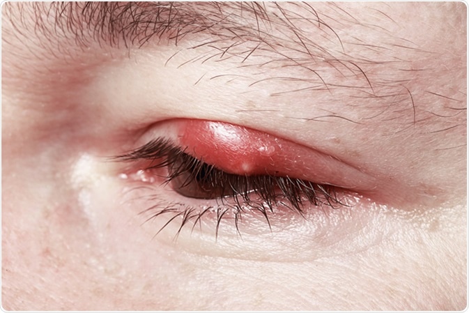 Blepharitis Inflammation - Image Credit: Gromovataya / Shutterstock